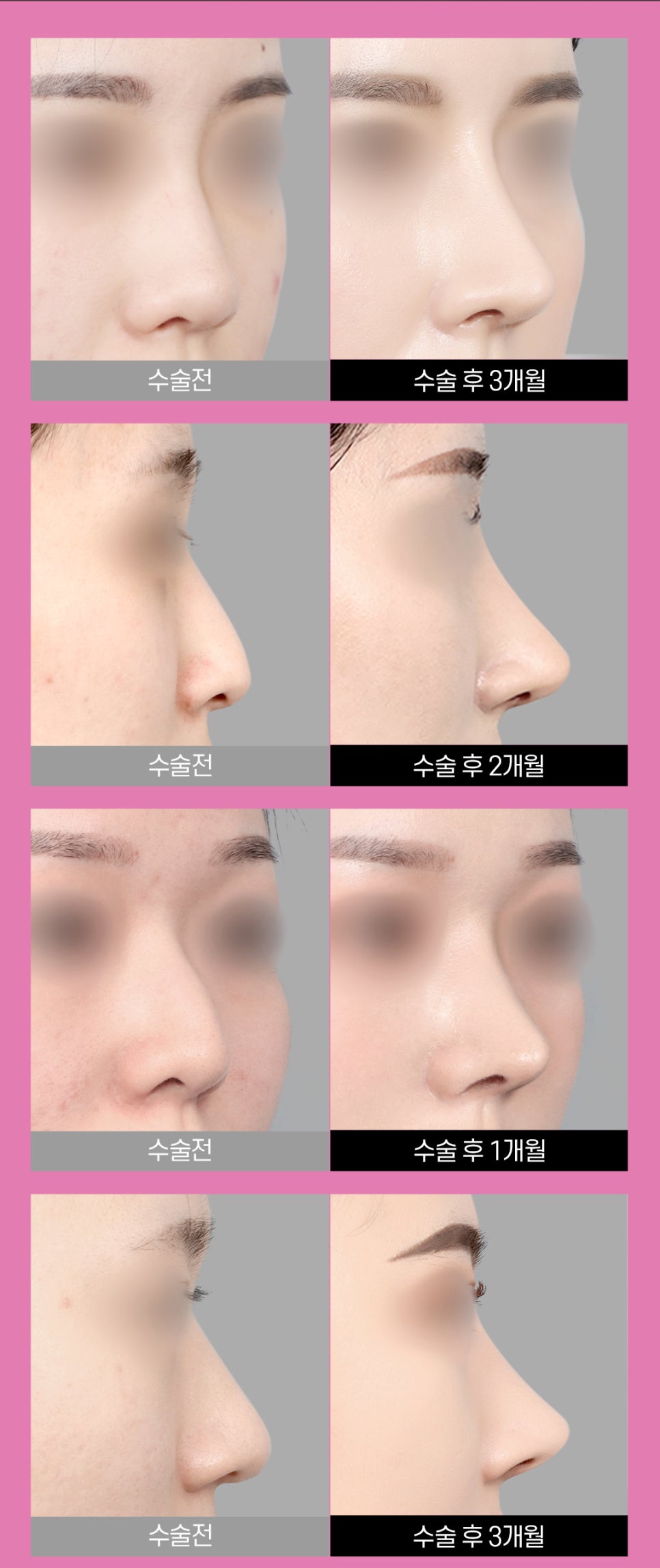 비염미용코성형 안전하고 확실하게 관련 이미지 6