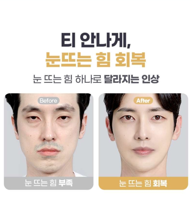 남자광대축소, 얼굴형과 옆광대 돌출을 함께 고려해야 하는 이유 관련 이미지 5