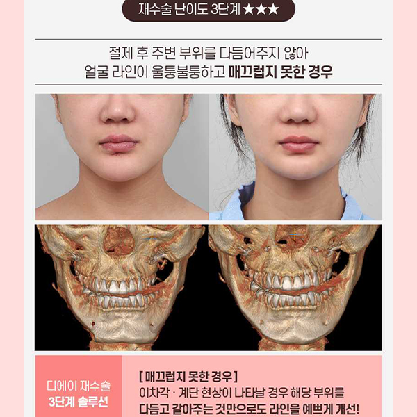 Not Satisfied After Your First Surgery? A Guide to Revision Facial Contouring Surgery image 8
