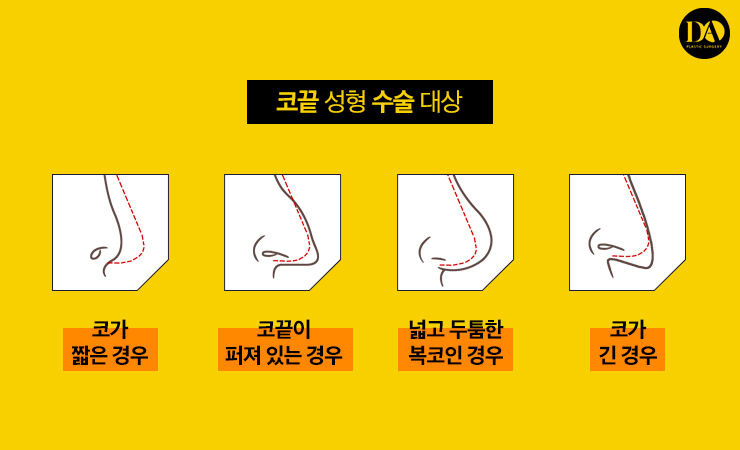 코 성형의 완성! 코끝 성형 관련 이미지 3