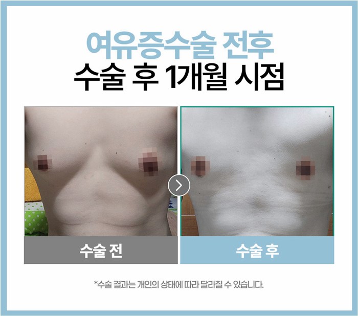 여성형유방증, 이런 경우 수술을 권장합니다. 관련 이미지 6