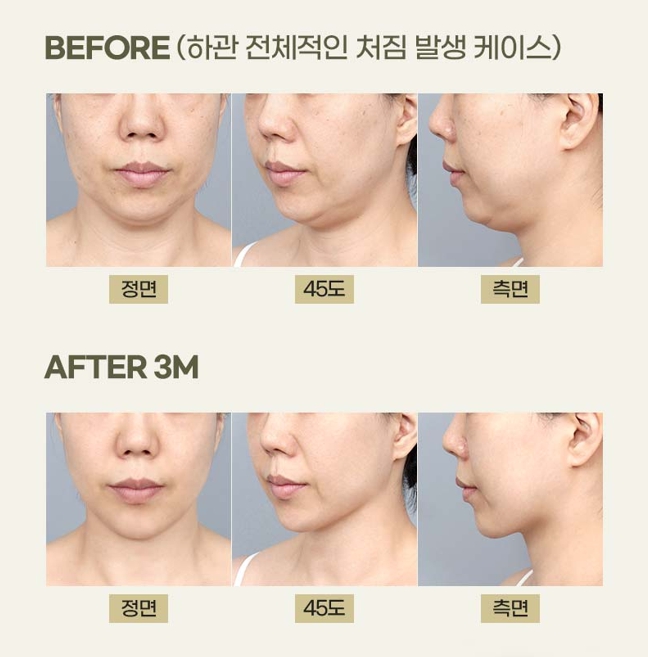 What Is Double-Chin Muscle Tightening? An Introduction to Improvement Methods by Cause image 13