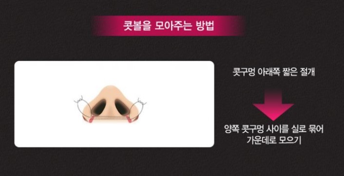이상적인 코성형, 그 방법은? 관련 이미지 12