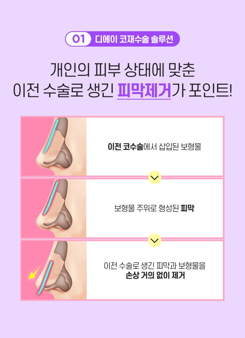 코재수술 알아볼 때 주의사항 관련 이미지 3