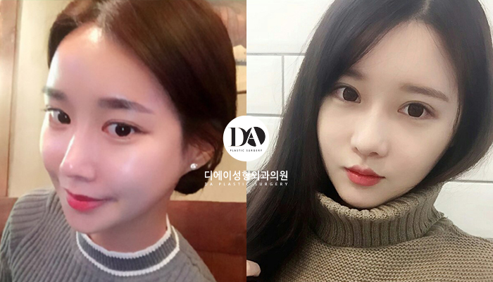 성공적인 눈성형, 관건은 눈형태에 따른 수술법 선택 관련 이미지 6