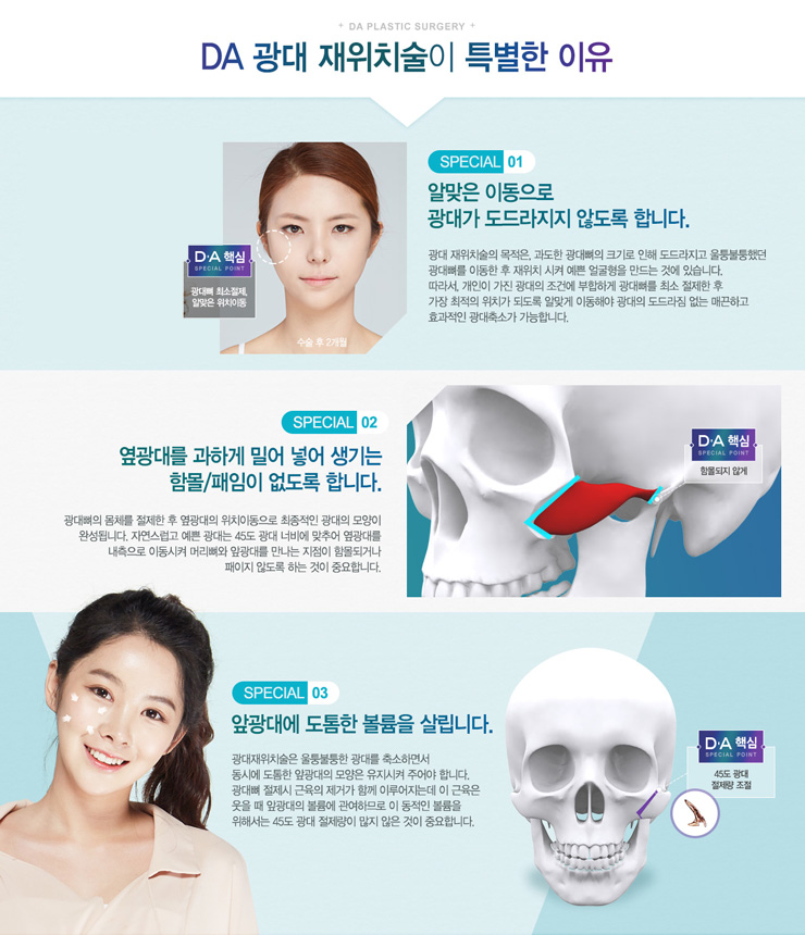 DA 광대 재위치술 관련 이미지 7