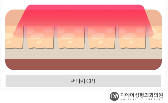 V라인 리프팅 종류 관련 이미지 6