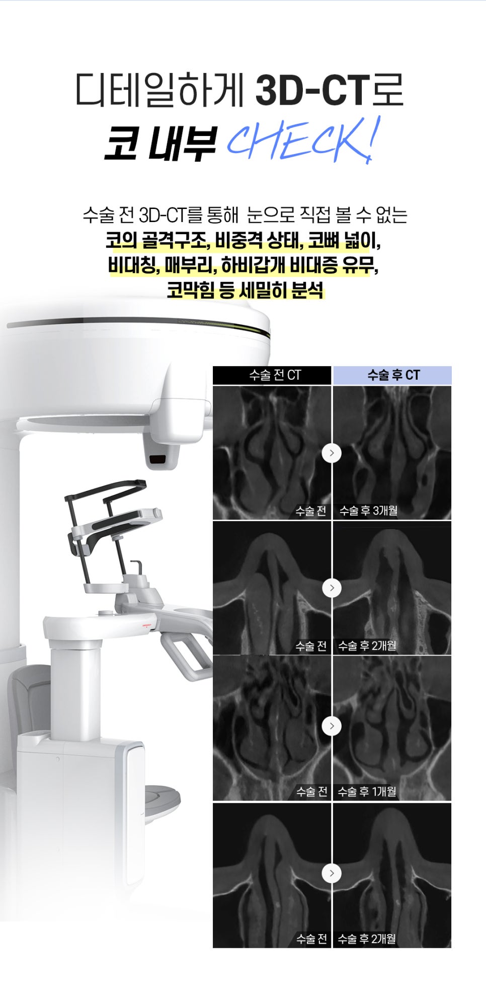남자코수술 비염 미용 두마리 토끼 잡으려면 관련 이미지 4