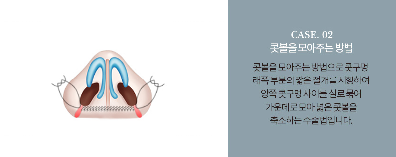 이상적인 코라인을 위한 유형별 코성형 관련 이미지 12