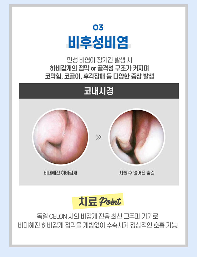 남자 기능코 수술 제대로 알고해야 관련 이미지 8