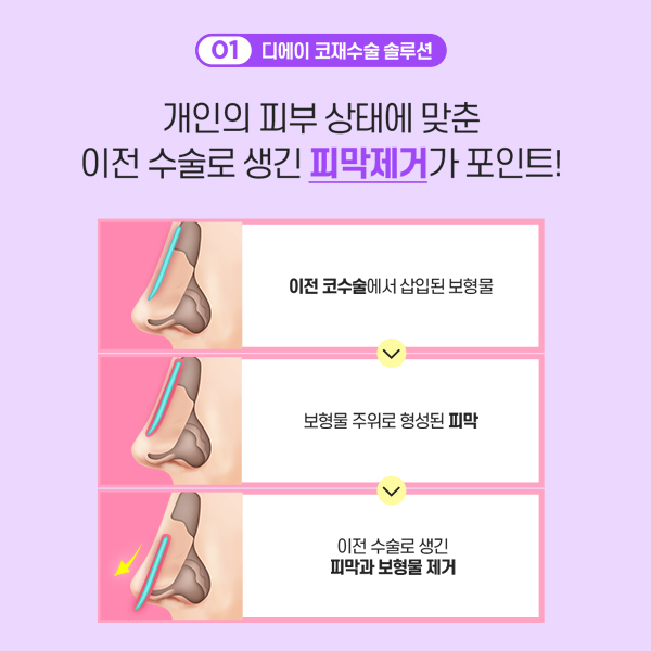 코재수술의 종착점, 더 이상 실패하지 않는 방법 관련 이미지 3