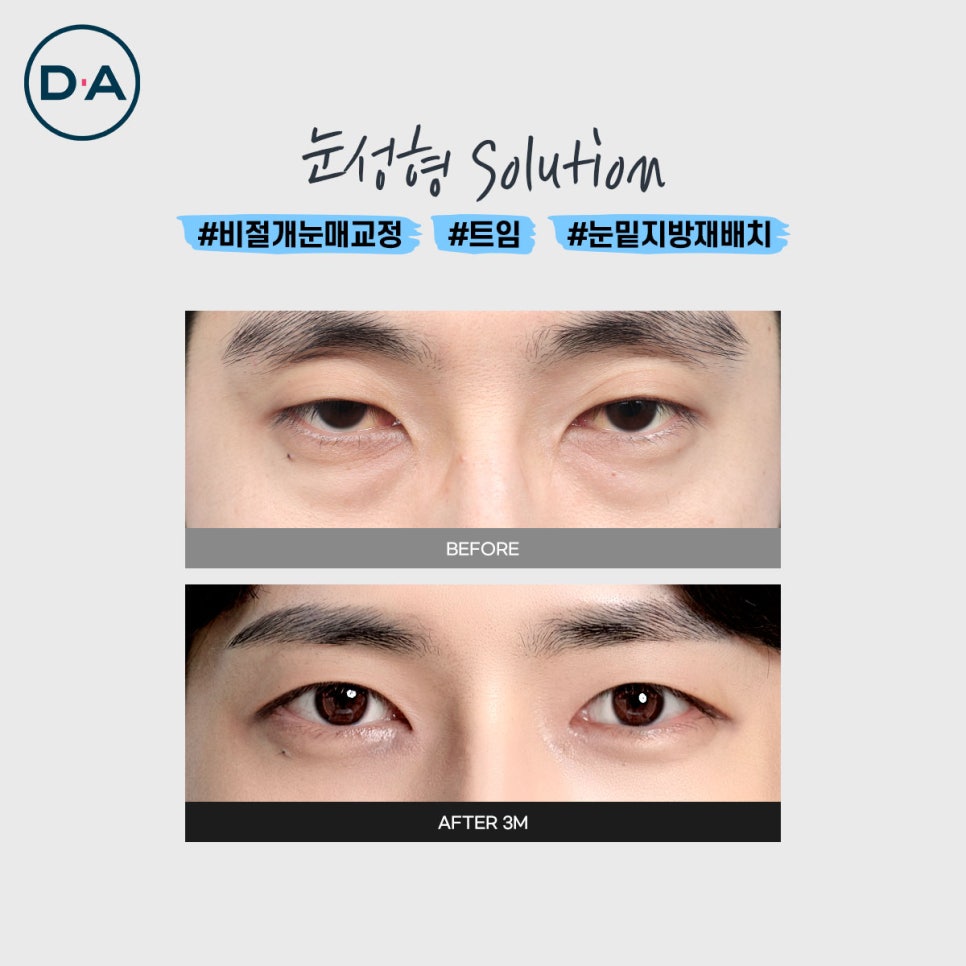 홍민기 수술전후 알아보자 - 무엇이든물어보살 성형남 관련 이미지 5