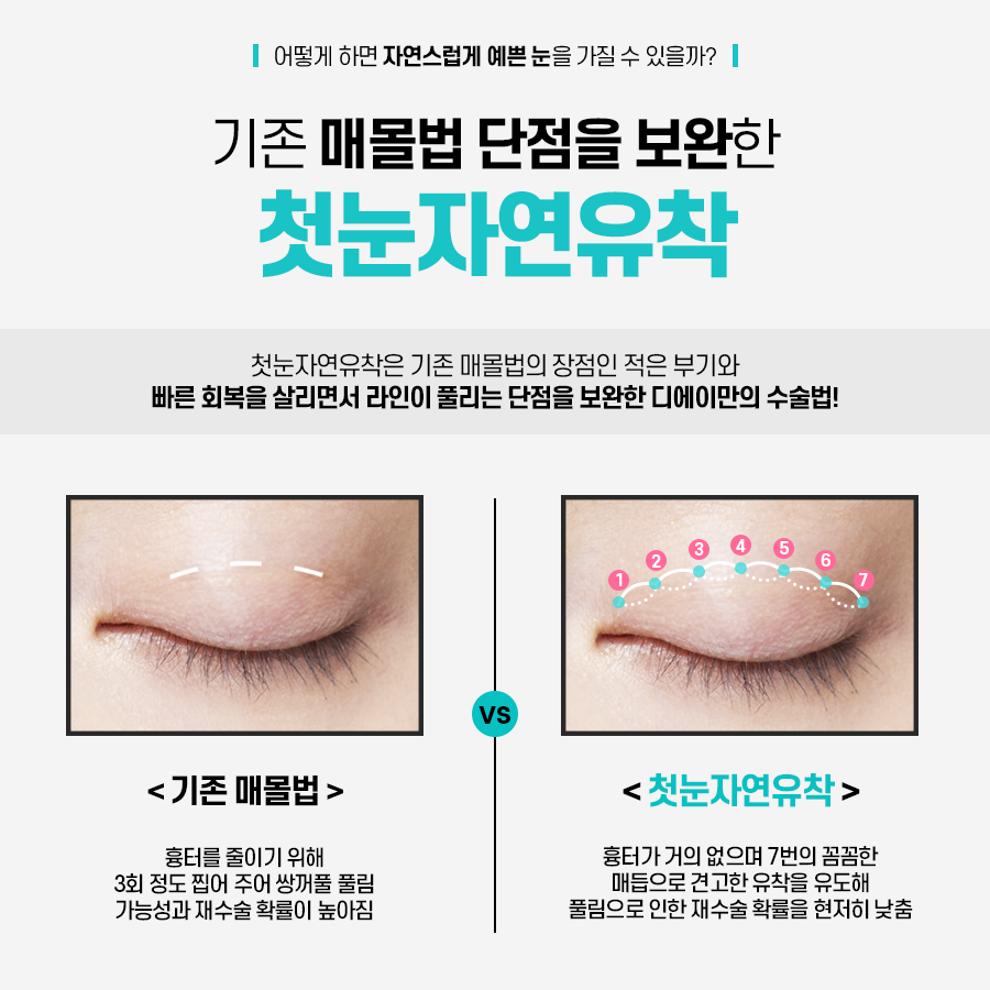 이미지에 맞게 라인 조절이 가능한 눈성형은? 관련 이미지 4