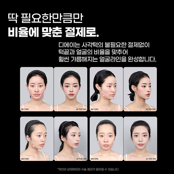 윤곽3종, 많이 깎는다고 예뻐지는 걸까? 관련 이미지 5