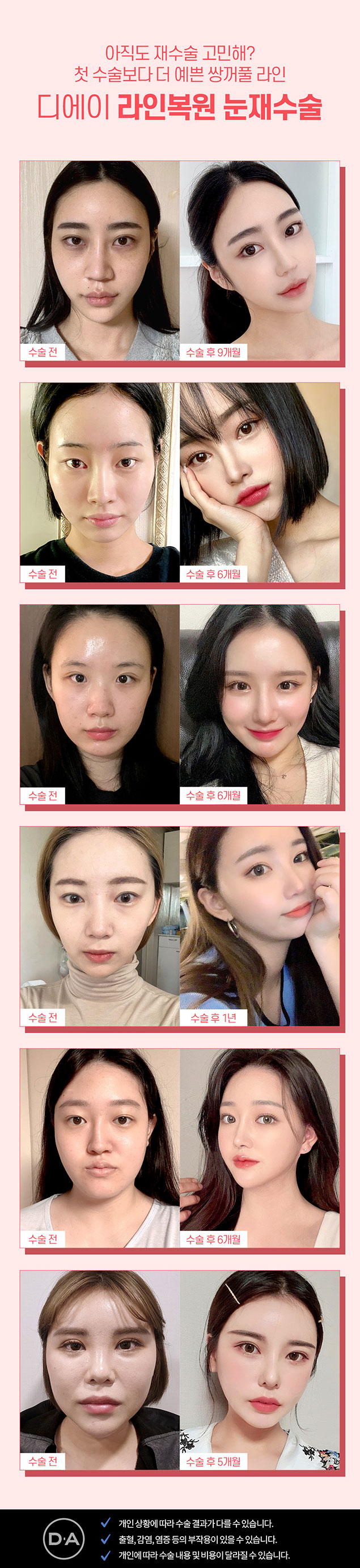 강남역 눈재수술 잘 하는 곳 관련 이미지 7