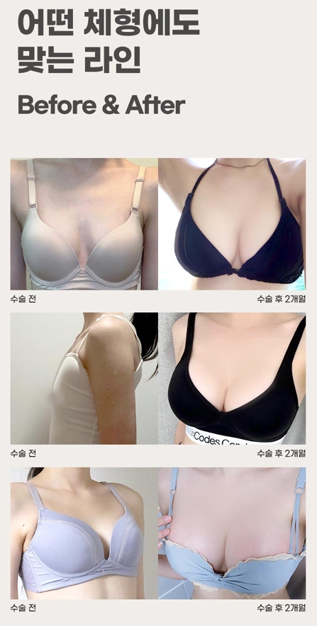 Key Points for Increasing Satisfaction with Bounce Breast Augmentation Using Implants image 3