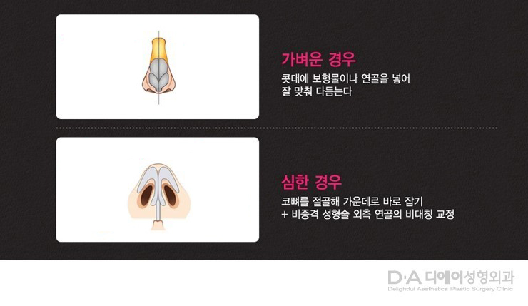 유형별 코성형의 특징과 방법 관련 이미지 16