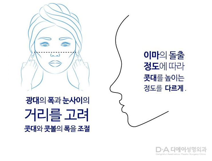유형별 코성형의 특징과 방법 관련 이미지 25