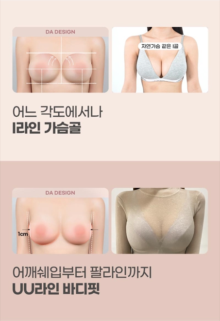 Key Points for Increasing Satisfaction with Bounce Breast Augmentation Using Implants image 5