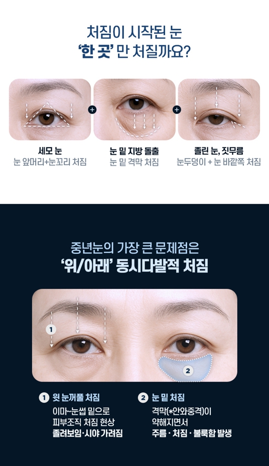 중년 눈성형, 처진 눈꺼풀의 원인에 따라 수술법이 달라집니다 관련 이미지 2