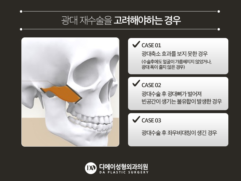 안면윤곽 재수술 체크리스트 관련 이미지 10