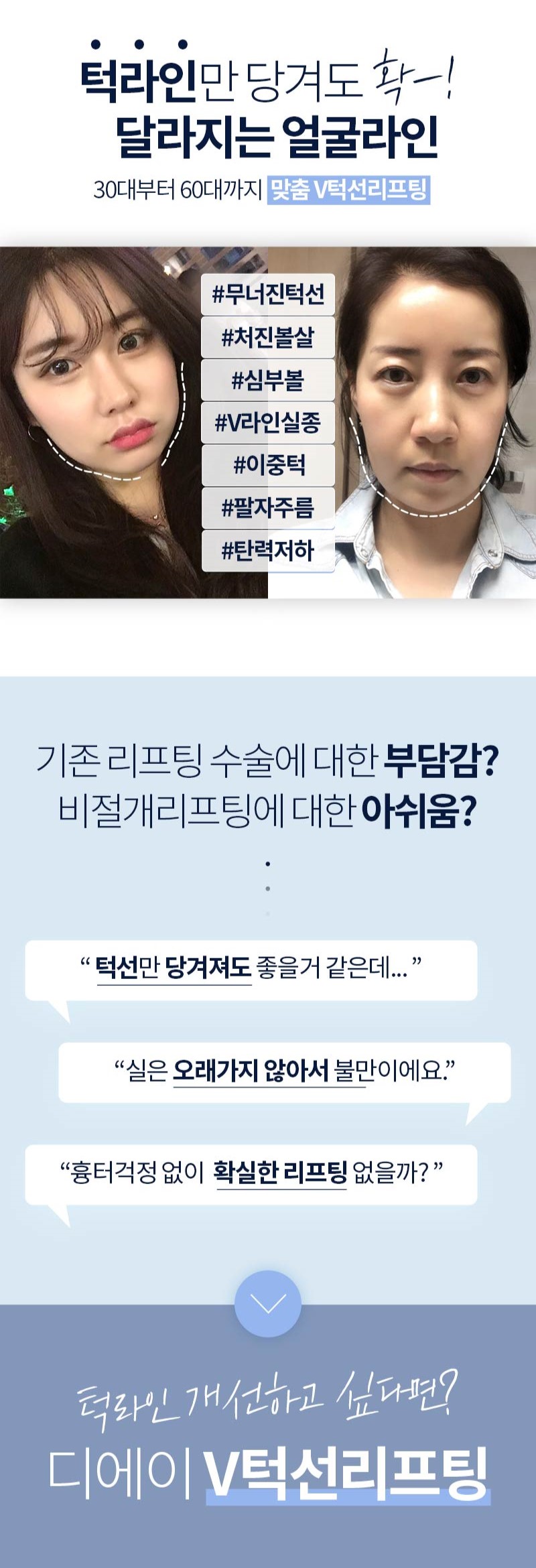 편리하고 확실하게 예뻐지는 방법 [디에이성형외과 : 턱선리프팅] 관련 이미지 3