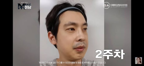 디에이성형외과 | 맥미남 시한폭탄내남자 개인인터뷰 근황 느낀점 관련 이미지 24