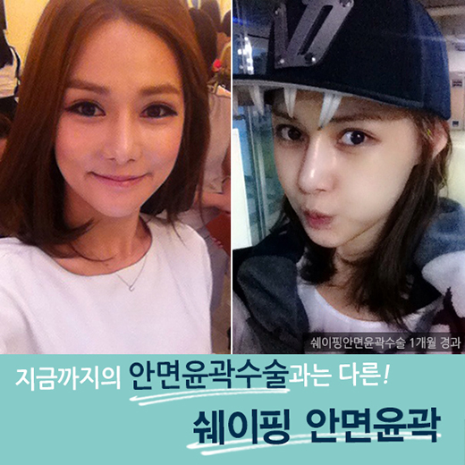 최소 절제, 최상의 효과! DA성형외과 쉐이핑안면윤곽 관련 이미지 1