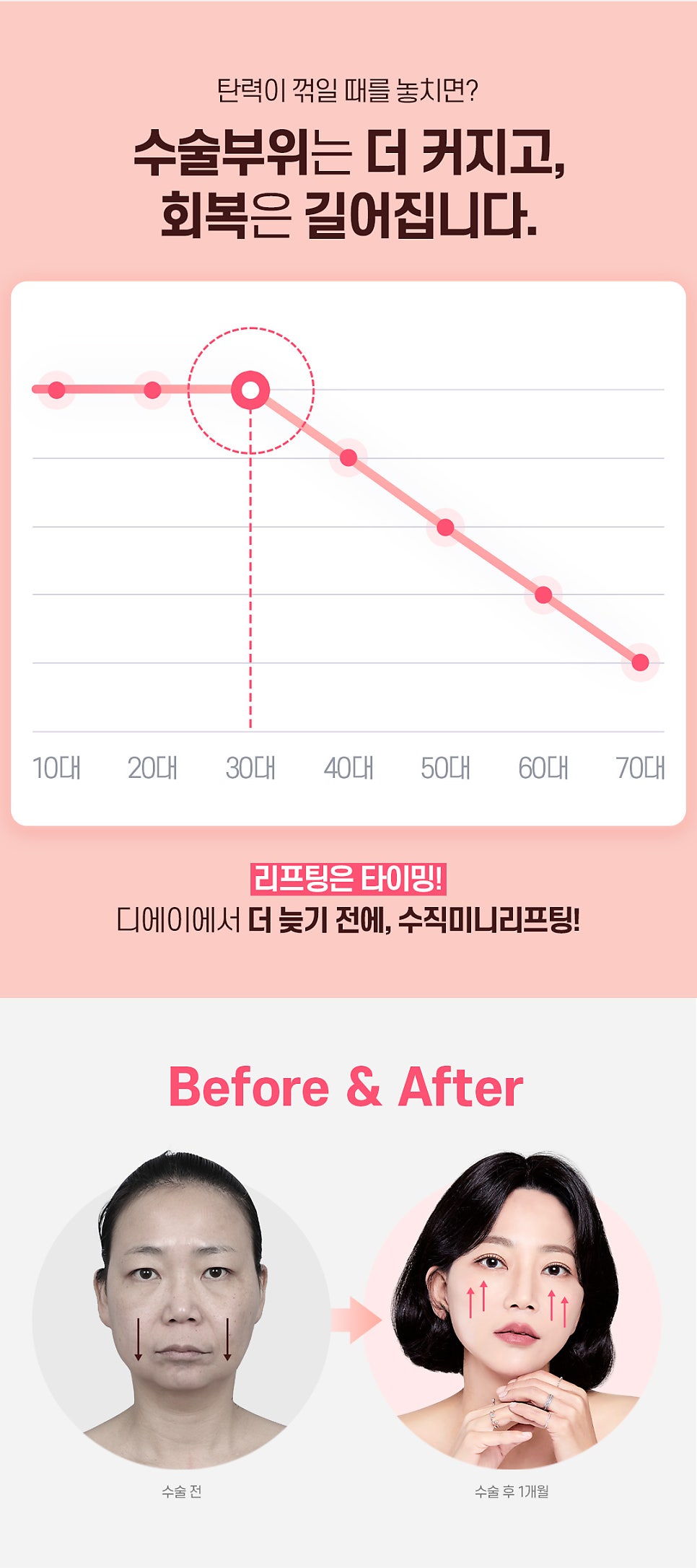 수직미니리프팅 수술법 가격 효과 알아보자면 관련 이미지 6