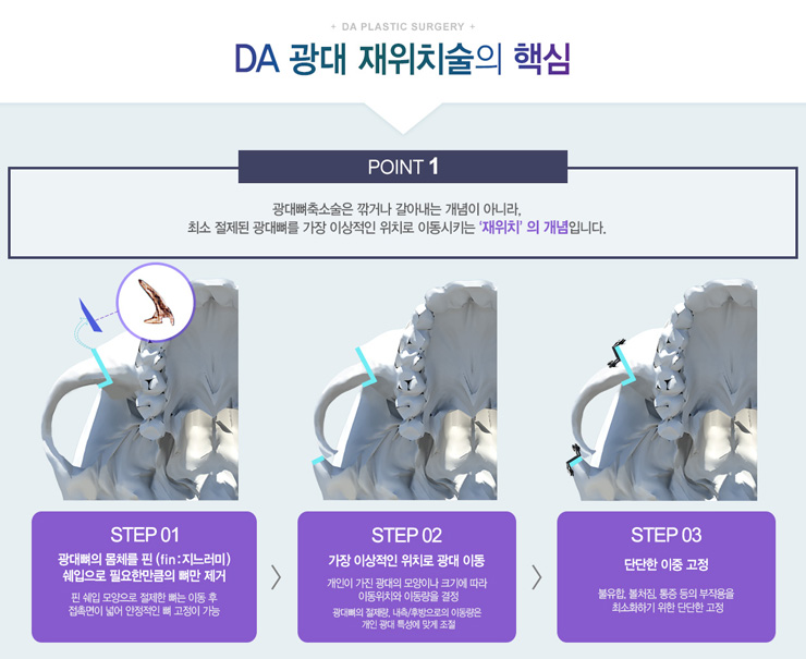 DA 광대 재위치술 관련 이미지 5