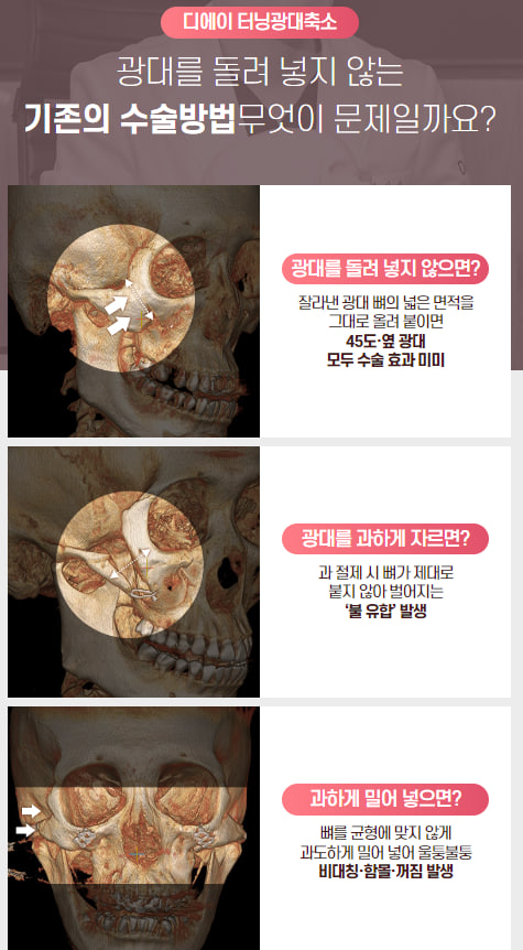 안전하지만 효과적으로, 광대축소술 관련 이미지 4