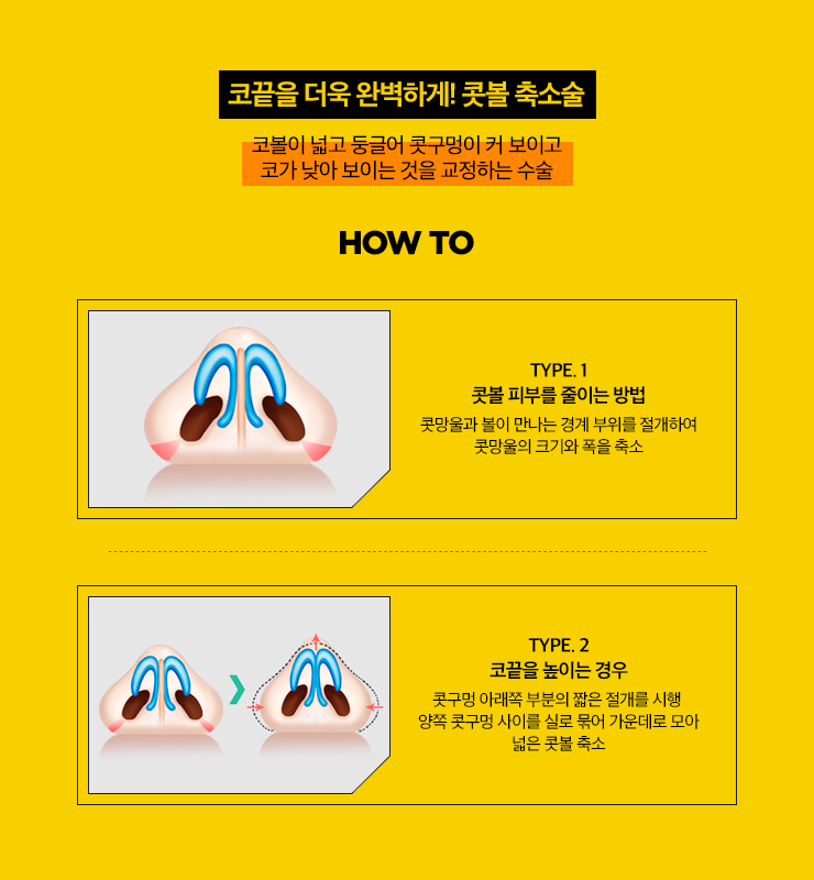 코 성형의 완성! 코끝 성형 관련 이미지 6