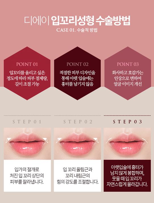 디에이성형외과 입꼬리성형으로 매력적인 미소를 가지다 관련 이미지 4