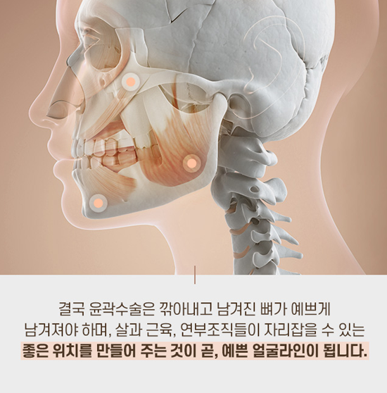 디에이 안면윤곽, 예쁘게 깎고 예쁘게 남기다 관련 이미지 7