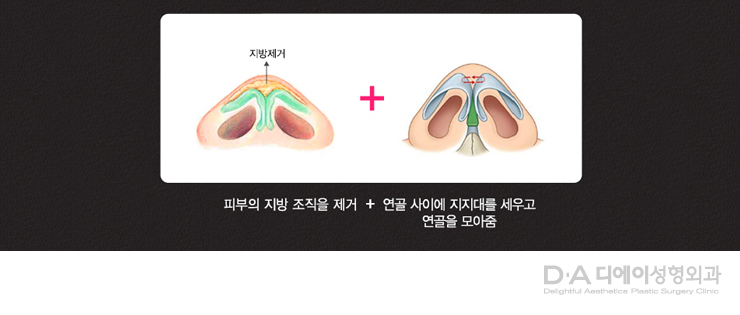 유형별 코성형의 특징과 방법 관련 이미지 8