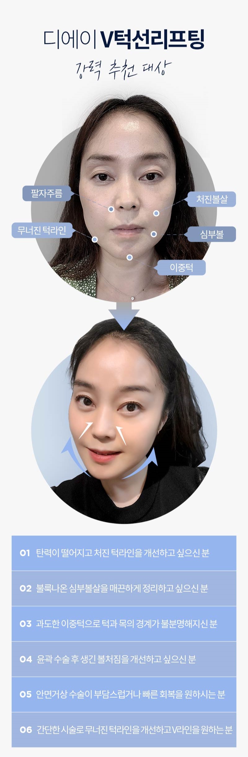 편리하고 확실하게 예뻐지는 방법 [디에이성형외과 : 턱선리프팅] 관련 이미지 5