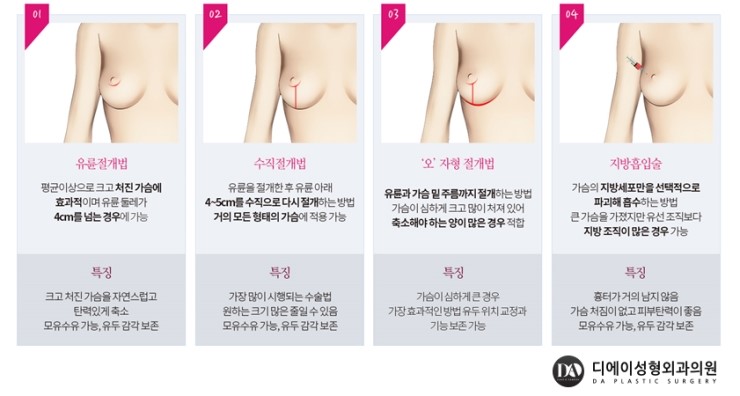 수술 전 내 가슴에 예쁜 보형물 미리 체크해보기 관련 이미지 11