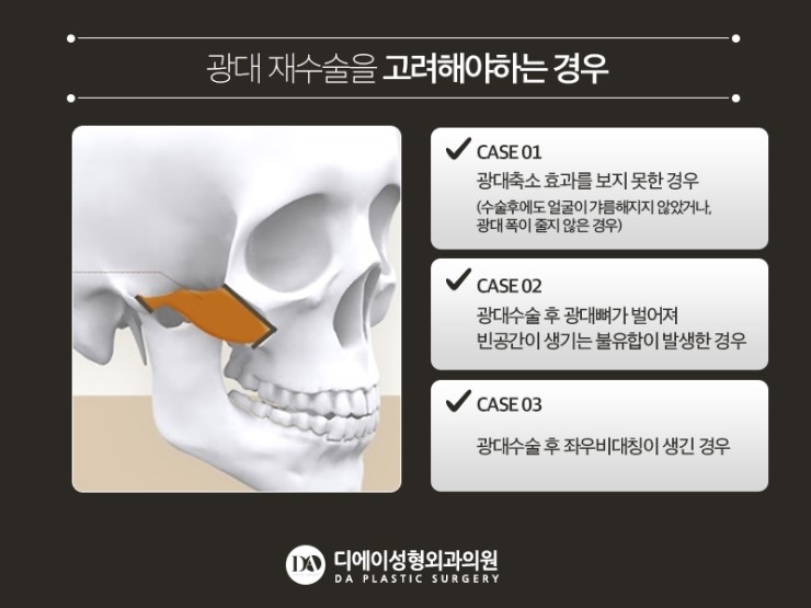 안면윤곽 재수술, 어떤 경우에 필요할까? 관련 이미지 10
