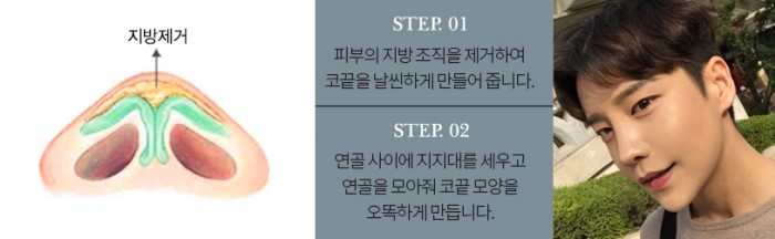 이상적인 코성형, 그 방법은? 관련 이미지 10