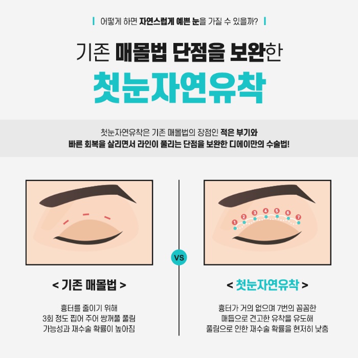 쌍꺼풀수술 후 풀림 현상을 예방하기 위해서는? 관련 이미지 4