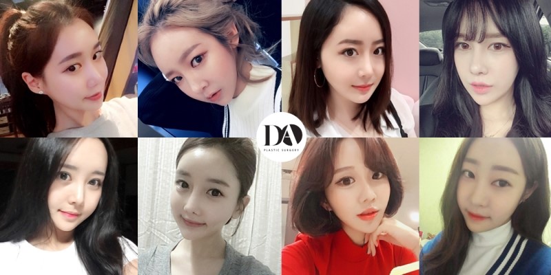 안면윤곽 재수술, 어떤 경우에 필요할까? 관련 이미지 17