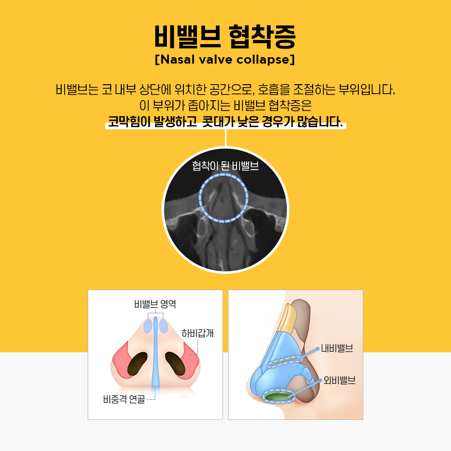 비염수술 코 내부의 구조적 문제를 해결해야 관련 이미지 7