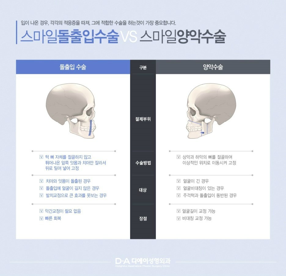 디에이 스마일 돌출입수술 관련 이미지 6