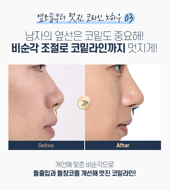 DA FOR MAN, 디에이성형외과 남자 코성형 관련 이미지 9