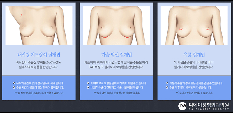 실패없는 가슴재수술 A~Z 관련 이미지 9