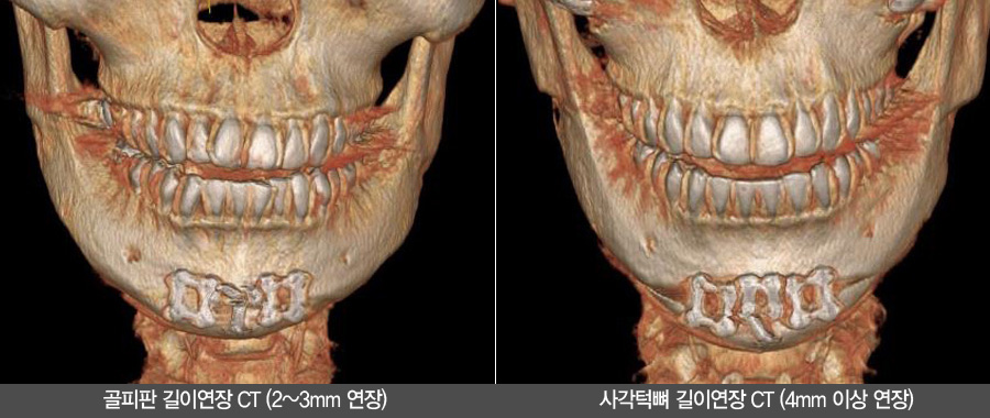 얼굴비율 바꾸는 턱끝길이연장 관련 이미지 5