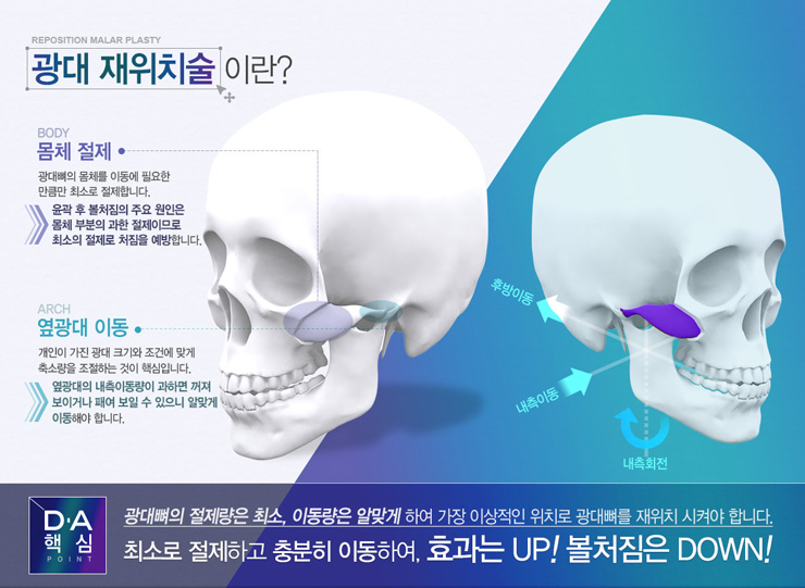 DA 광대 재위치술 관련 이미지 4