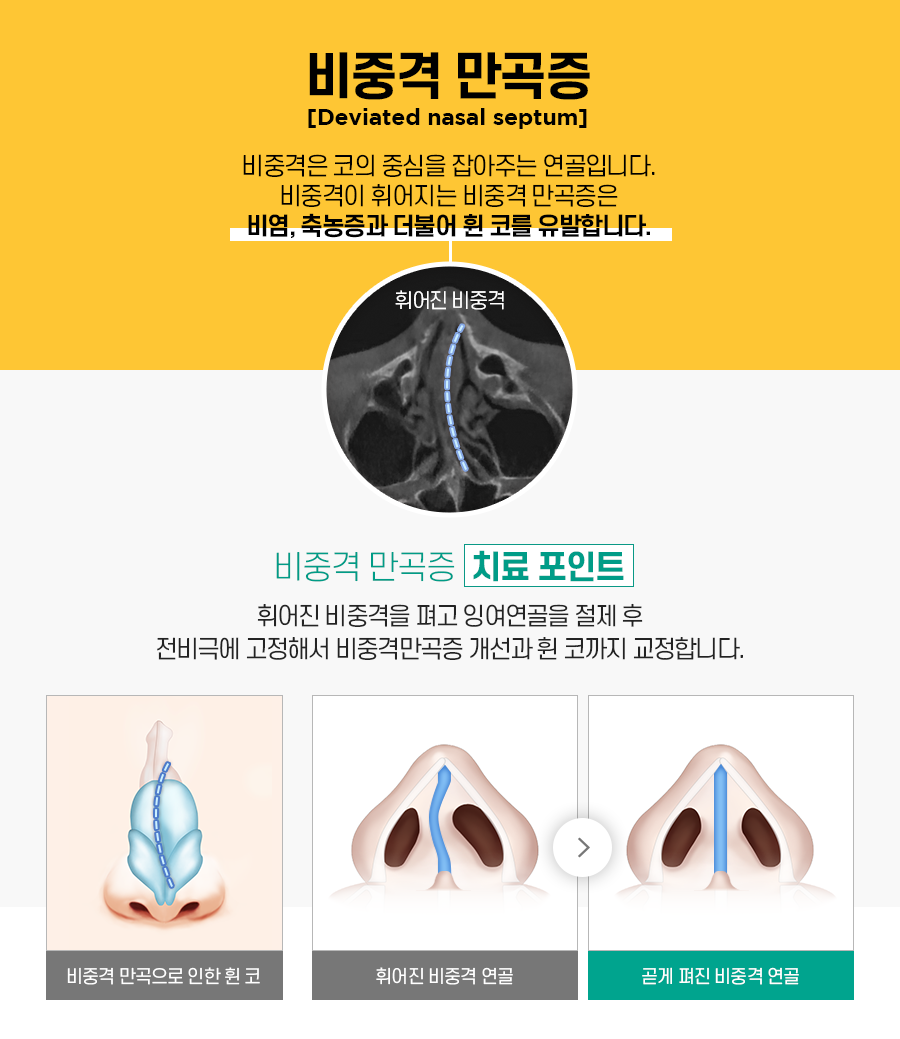 비염수술 코 내부의 구조적 문제를 해결해야 관련 이미지 6