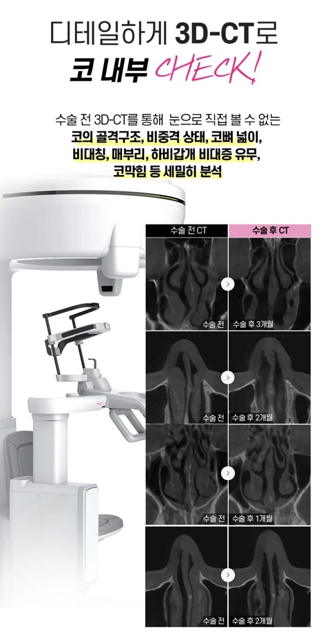 비염미용코수술, 코막힘과 코 모양을 함께 고려하려면 관련 이미지 5