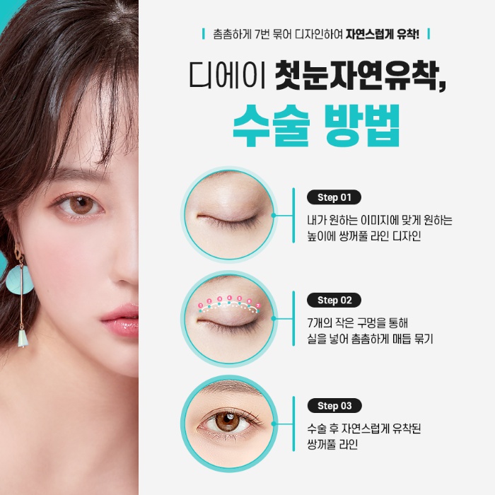 쌍꺼풀수술 후 풀림 현상을 예방하기 위해서는? 관련 이미지 8
